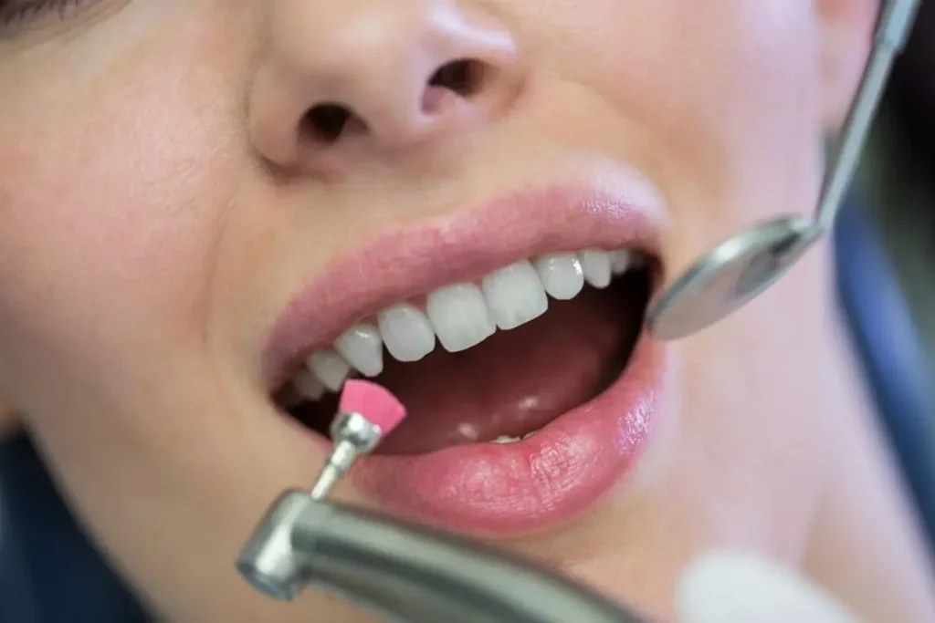 Duración de las carillas dentales