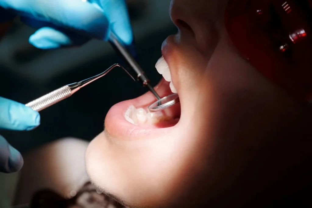 Procedimiento para extraer una muela con endodoncia