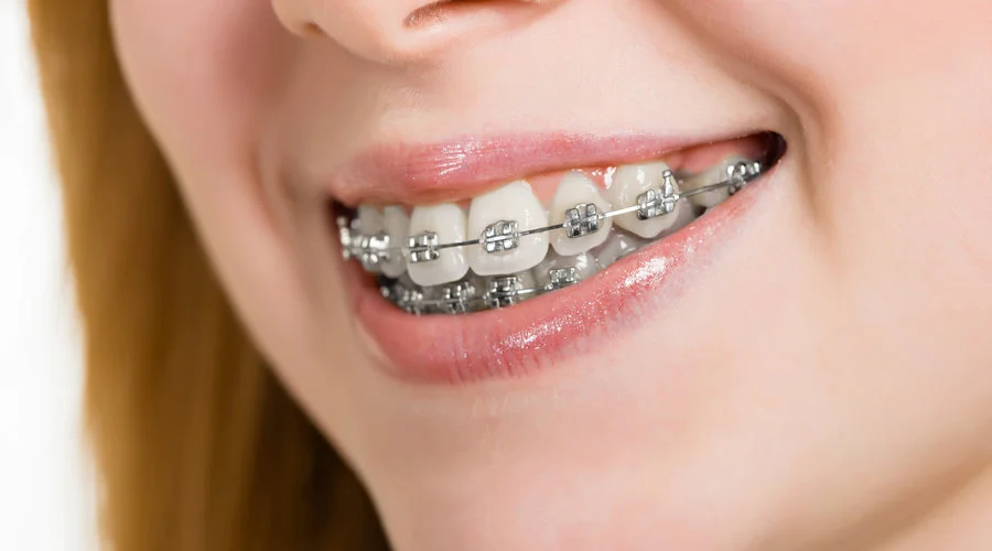 Cuanto tiempo se llevan los brackets: guía actualizada 2026 3 Duración de los brackets en niños