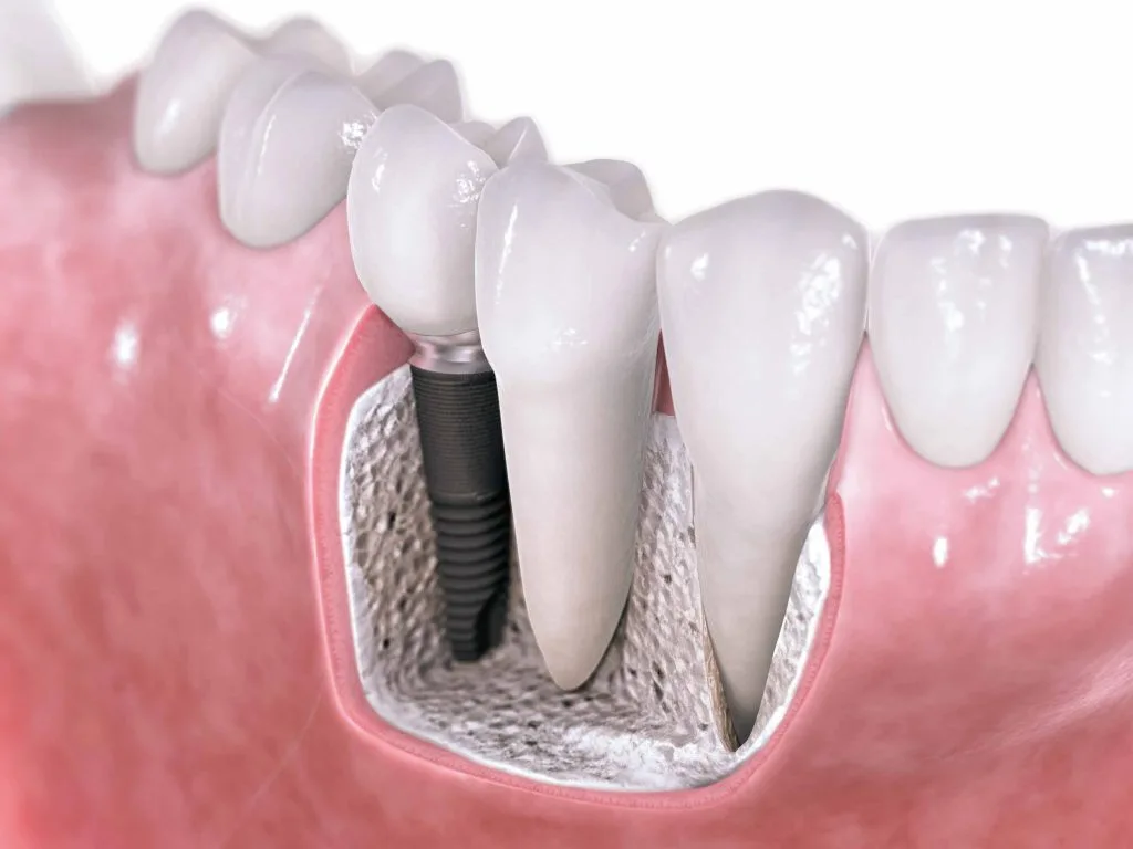 Implante dental sin tornillo precio: Costes reales y comparativas 2026 3 Tipos de implantes dentales sin tornillos