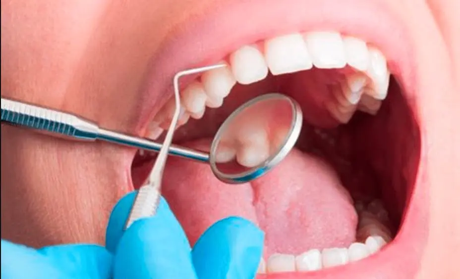 Curetaje dental precio: Coste real por cuadrante en 2026 4 Cuánto cuesta un curetaje dental