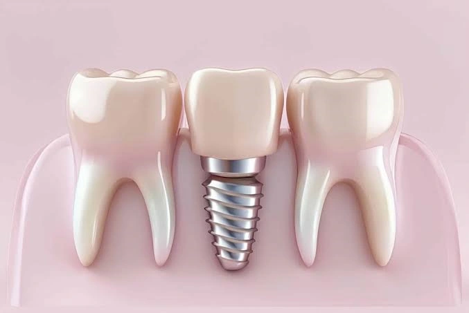 Implante dental sin tornillo precio: Costes reales y comparativas 2026 2 Cuánto cuesta un implante dental sin tornillo