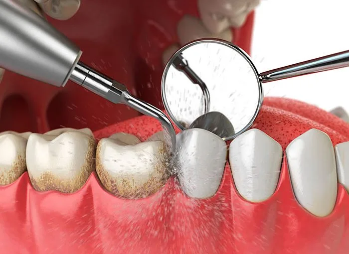Curetaje dental precio: Coste real por cuadrante en 2026 2 Curetaje dental