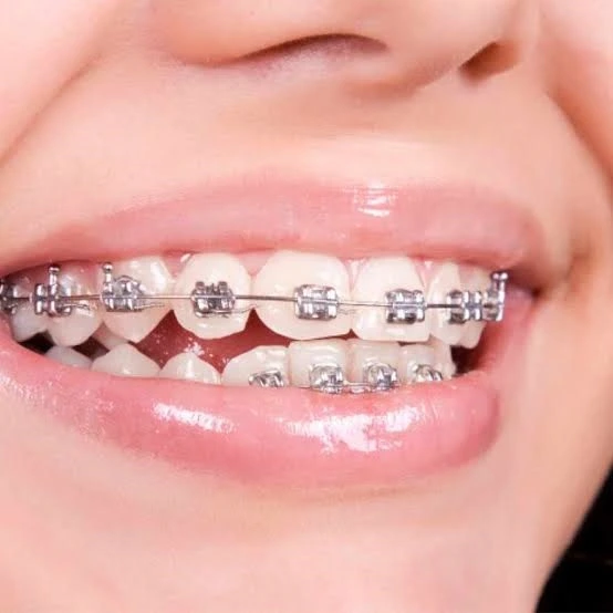 Cuanto tiempo se llevan los brackets: guía actualizada 2026 1 Duración de la ortodoncia con brackets