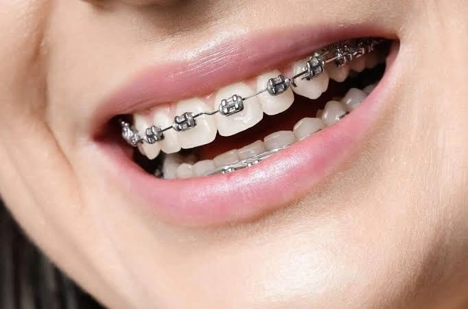 Cuanto tiempo se llevan los brackets: guía actualizada 2026 2 Media de tiempo habitual en tratamientos de ortodoncia
