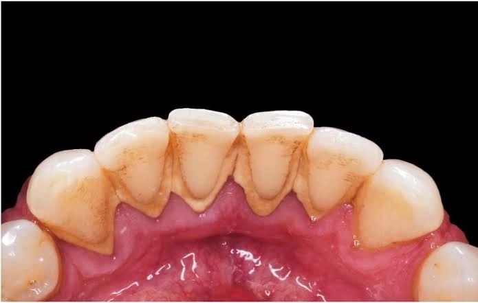 Curetaje dental precio: Coste real por cuadrante en 2026 3 Por qué el curetaje dental se divide en cuadrantes