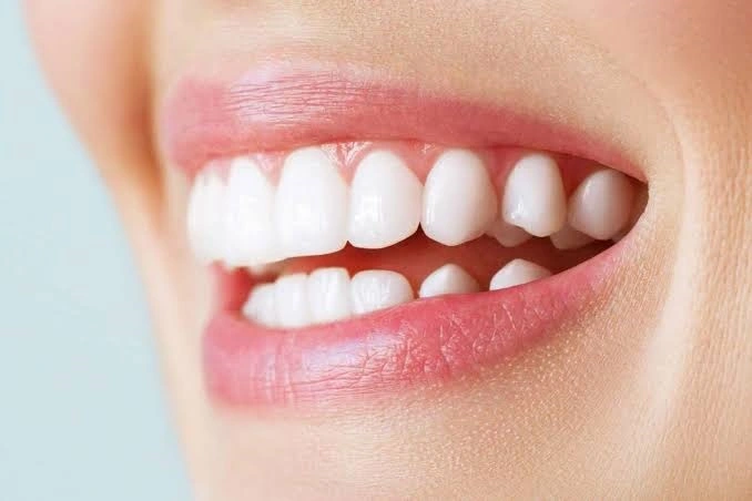 Implante dental sin tornillo precio: Costes reales y comparativas 2026 4 Precio de un implante dental sin tornillo