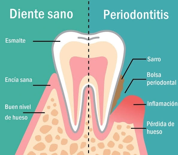 Curetaje dental precio: Coste real por cuadrante en 2026 1 Precio del curetaje dental