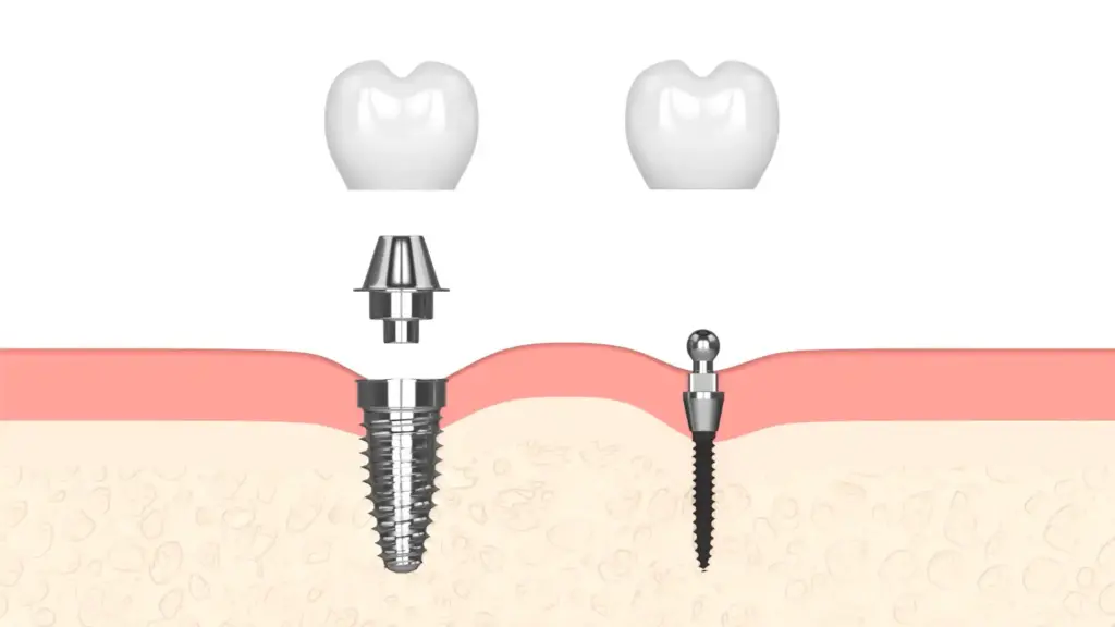 Implante dental sin tornillo precio: Costes reales y comparativas 2026 1 Qué es un implante dental sin tornillo