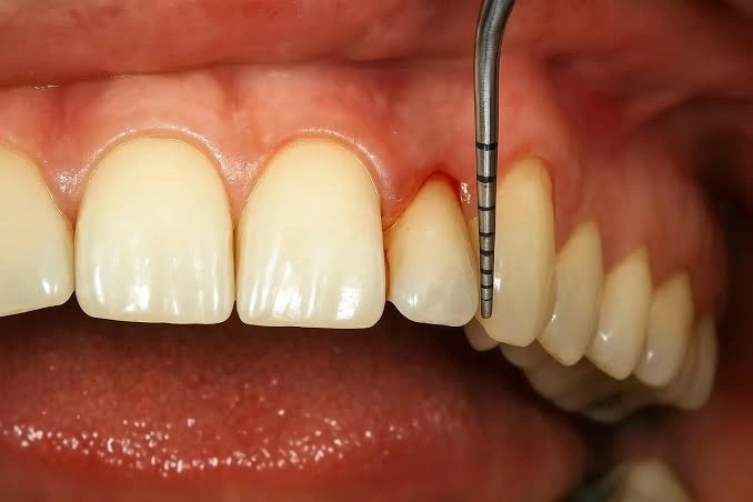 Qué es un mantenimiento periodontal: Guía completa 2 Cuánto cuesta el mantenimiento periodontal