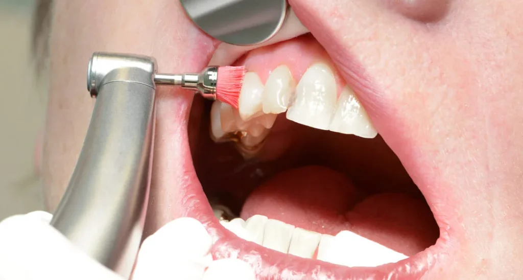 Qué es un mantenimiento periodontal: Guía completa 3 Qué es un mantenimiento periodontal