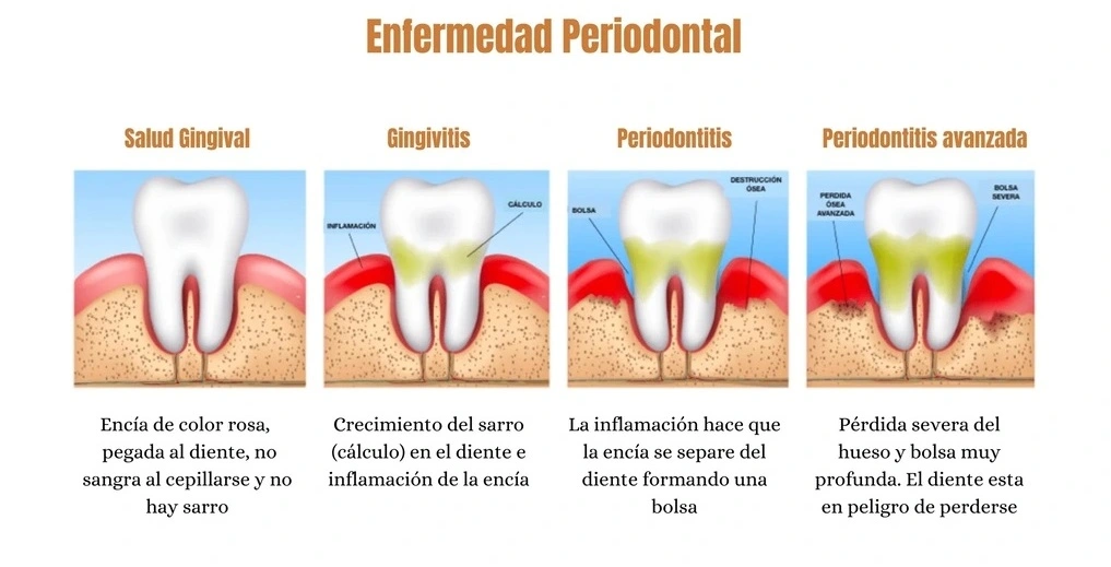 Qué es un mantenimiento periodontal: Guía completa 1 Qué se hace en un mantenimiento periodontal