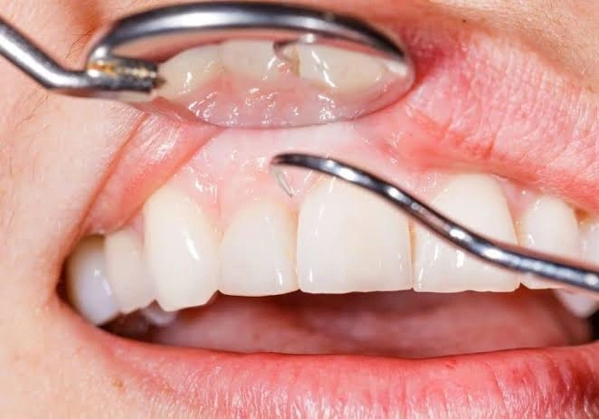 Qué es un mantenimiento periodontal: Guía completa 4 Duele hacerse un mantenimiento periodontal