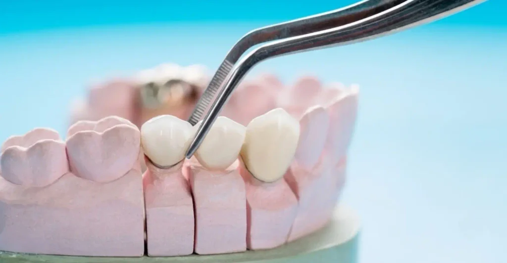 Tipos de coronas dentales y precios en España: Guía completa 2026 3 Qué es una corona dental y cuándo es necesaria