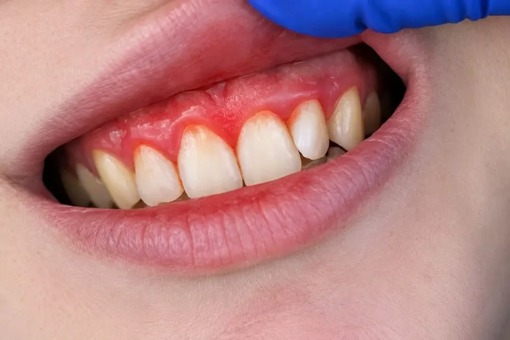 Qué es periodontitis y cómo tratarla 3 Tratamientos para frenar la periodontitis
