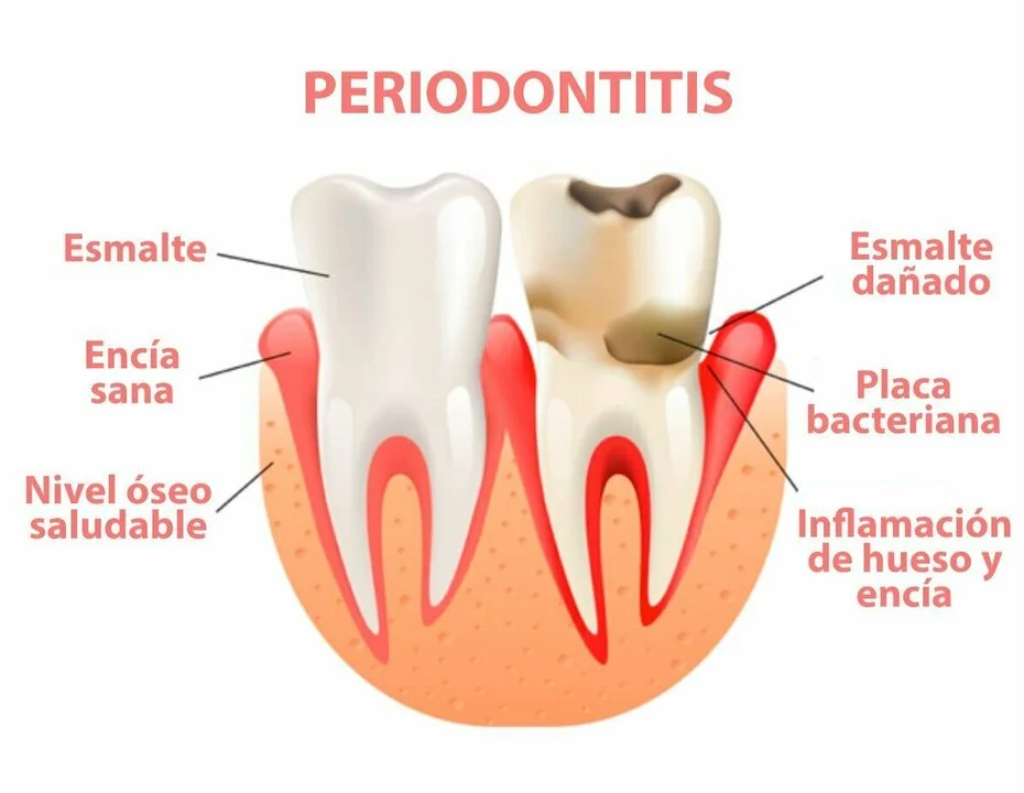 Qué es periodontitis y cómo tratarla 1 causas de la periodontitis