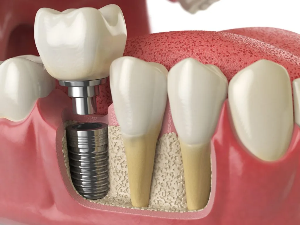 Injerto de hueso dental precio: cuánto cuesta, tipos y cuándo es necesario 4 Tipos de injerto de hueso dental