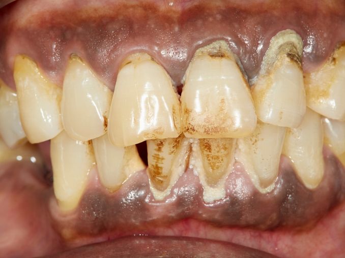 ¿La periodontitis se contagia? Claves, vías de transmisión 4 como se ve la periodontitis