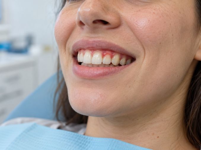 ¿La periodontitis se contagia? Claves, vías de transmisión 2 como se ve la gingivitis