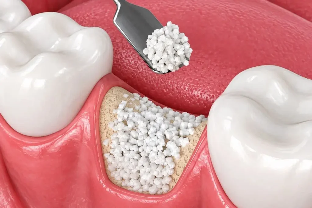 Injerto de hueso dental precio: cuánto cuesta, tipos y cuándo es necesario 3 cuanto cuesta un injerto de hueso dental