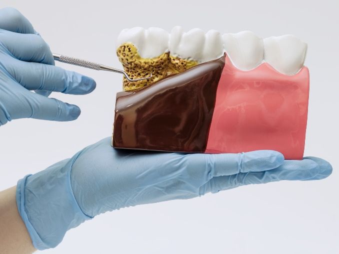 ¿La periodontitis se contagia? Claves, vías de transmisión 1 es contagiosa la periodontits y la gengivitis