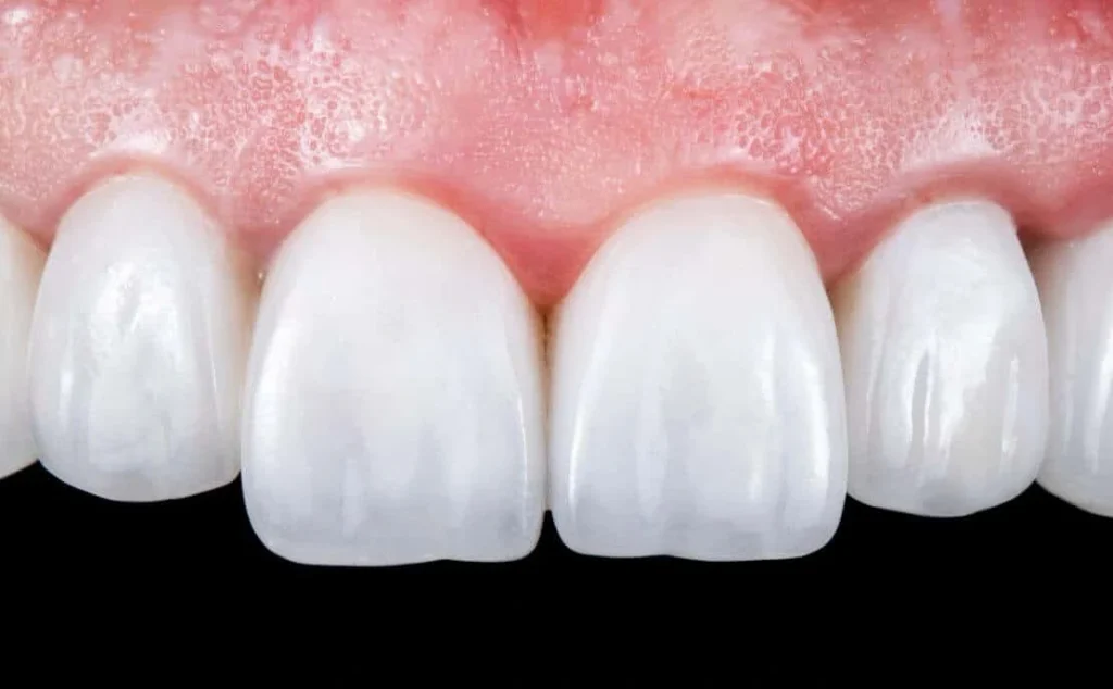 Precio de la reconstrucción dental