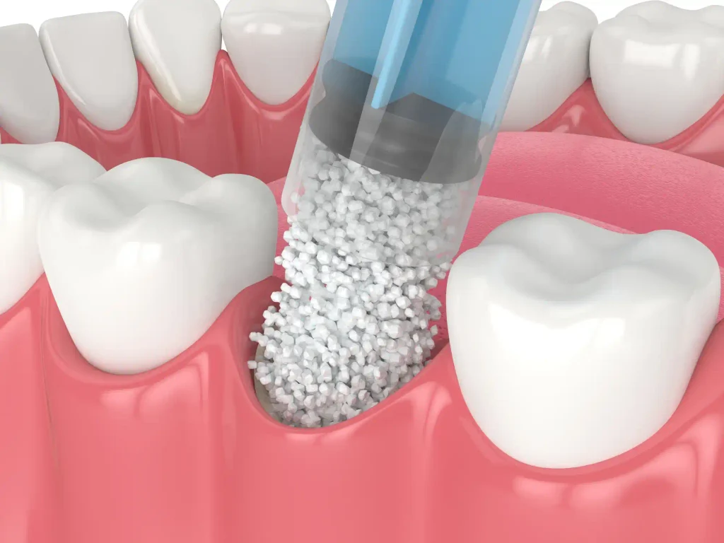 Injerto de hueso dental precio: cuánto cuesta, tipos y cuándo es necesario 1 precio de un injerto de hueso dental